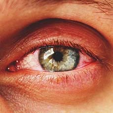 Kuru Göz Sendromu